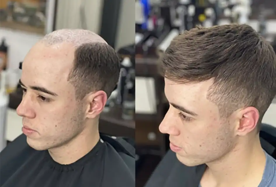 Mens Hair Replacement Systems | Non Surgical Hair Replacement