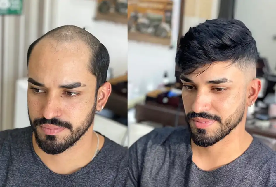 Melbourne men's hair replacement solutions
